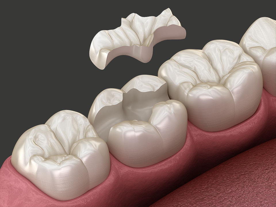 3D-Rendering vom Einsetzen der Inlays