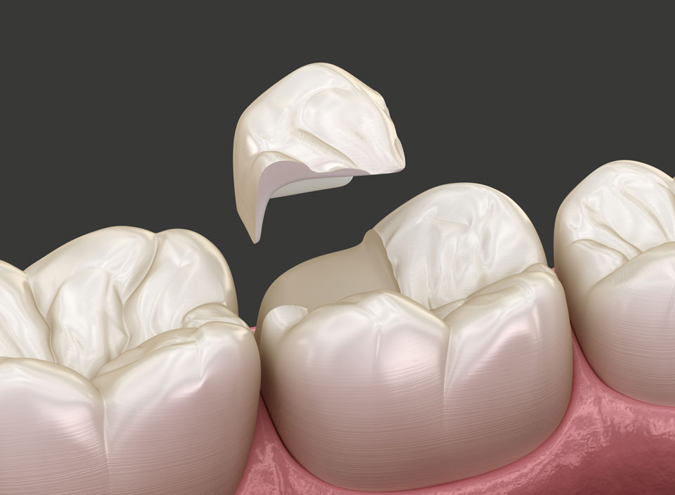 3D-Rendering vom Einsetzen der Teilkronen