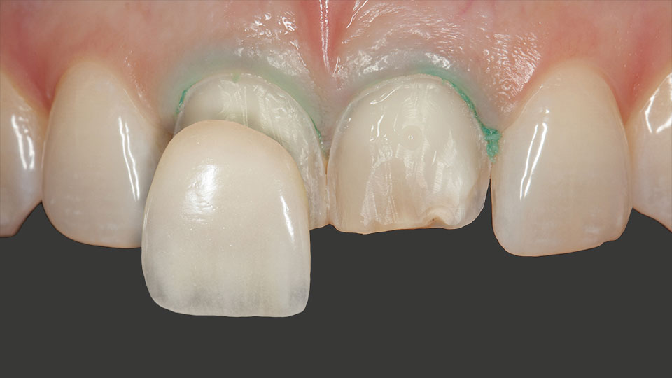 Veneers werden eingesetzt