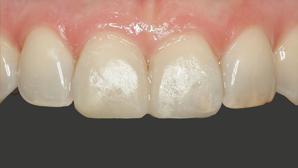 Fertige Zahnfront mit Veneers