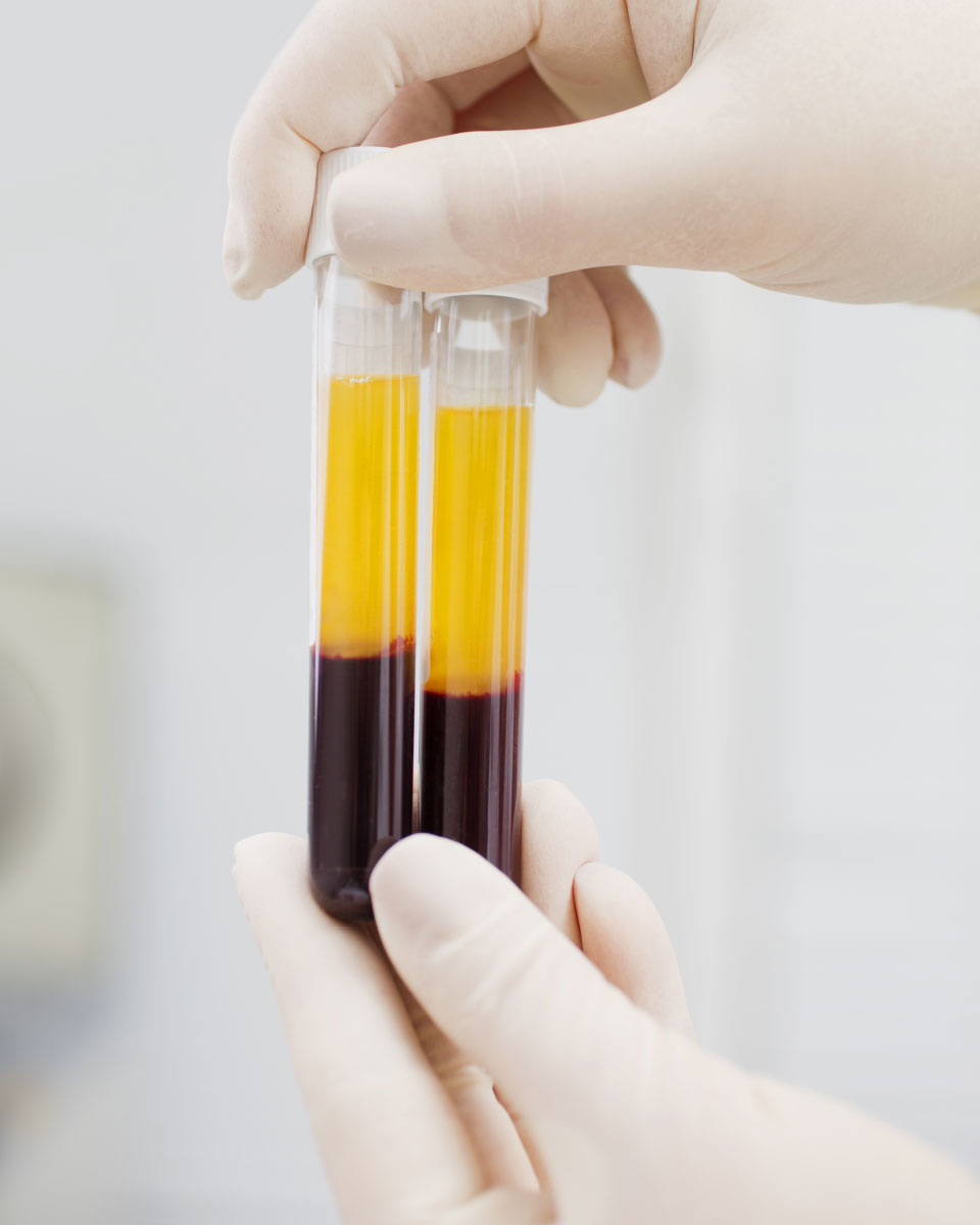 Reagenzgläser mit Eigenblut