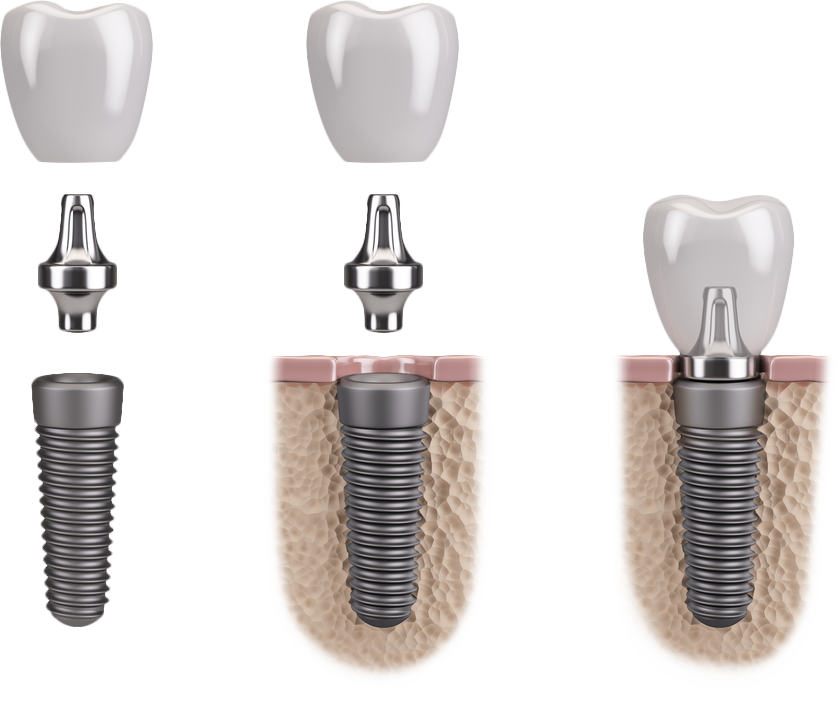 Schema vom Einsetzen des Implantats